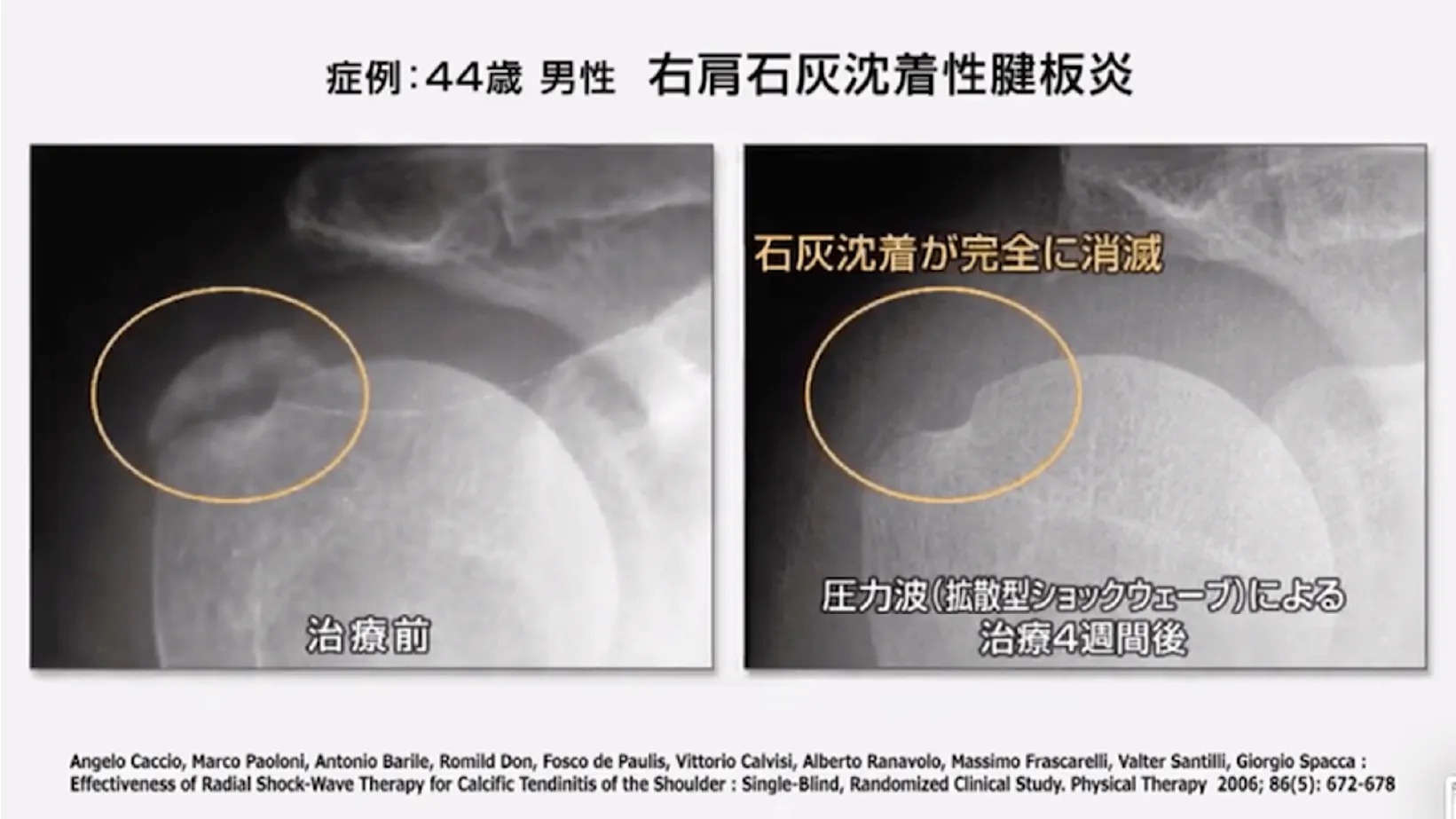 石灰沈着性腱板炎